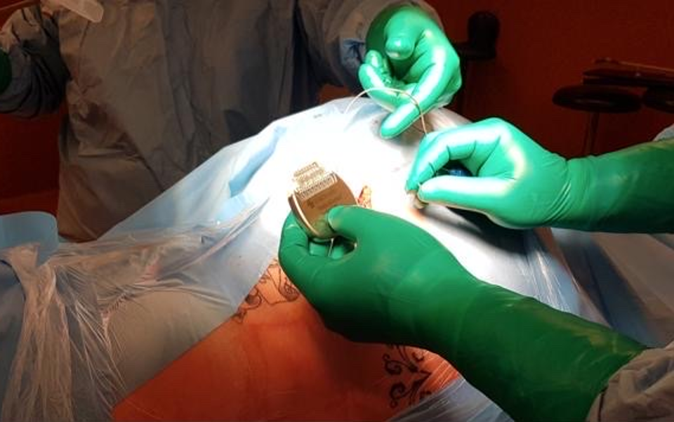 Primera  implantació d’un neuroestimulador medul·lar a l'HNSM